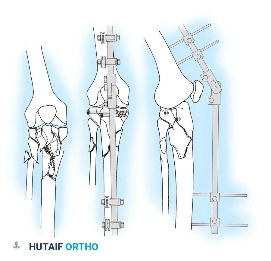 Fig. 50-21 Examples of cancellous and cortical screws for fracture ﬁ xation.
