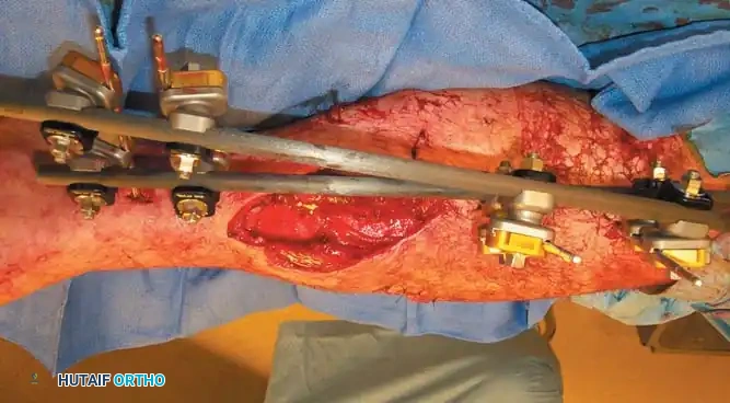 External Fixation Pins