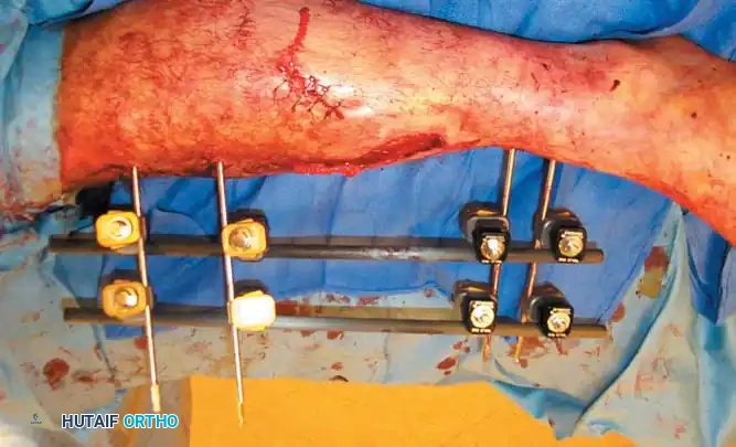 External Fixation Details