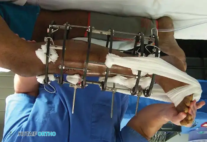 External Fixation Construct