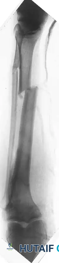 External Fixation Details