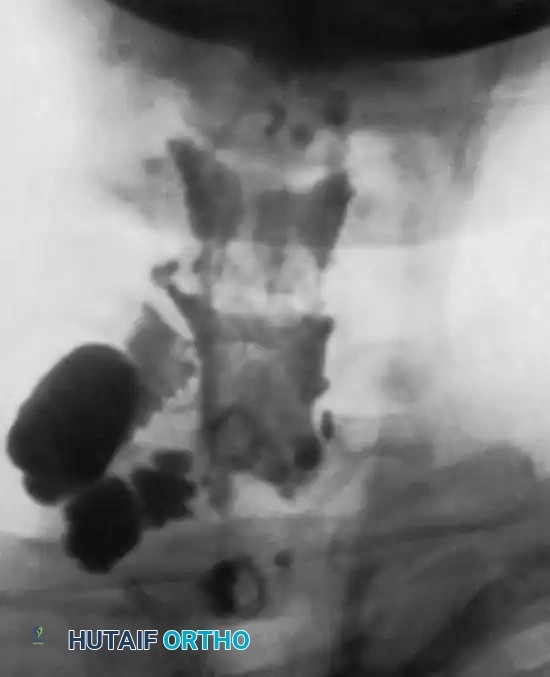 Fig. 59-18 Pantopaque myelogram showing pseudomeningocele produced by avulsion of roots of C7 and C8; C5 and C6, which also were avulsed, did not ﬁ ll. T1 still functions.