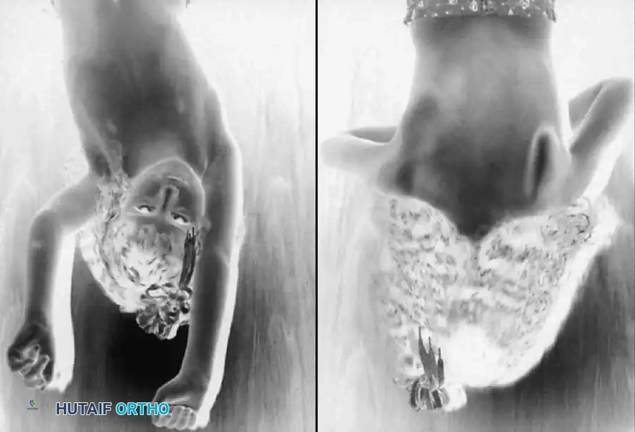 Brachial Plexus Birth Palsy: Comprehensive Surgical Guide