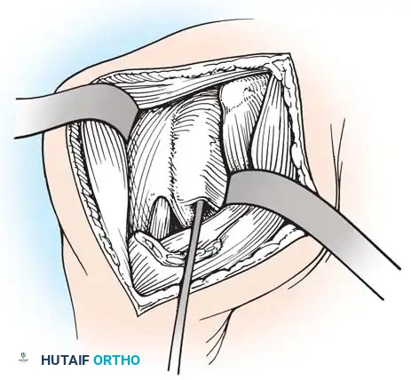 Fig. 31-60 Anterior shoulder release for internal rotation contracture in brachial plexus palsy.