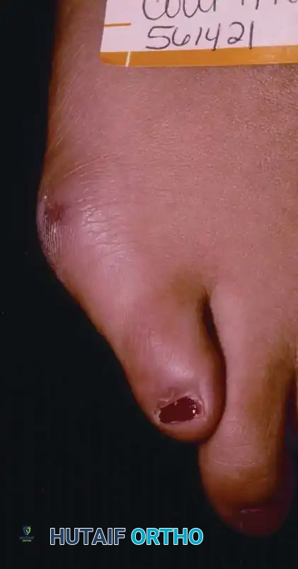 Comprehensive Surgical Management of Bunionette (Tailor’s Bunion)