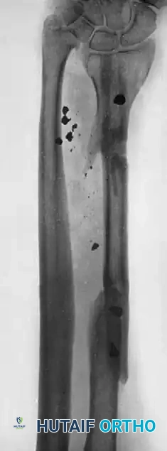 CANCELLOUS INSERT GRAFTS Surgical Diagram