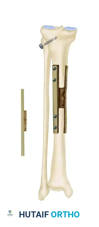 CANCELLOUS INSERT GRAFTS Surgical Diagram