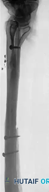 CANCELLOUS INSERT GRAFTS Surgical Diagram