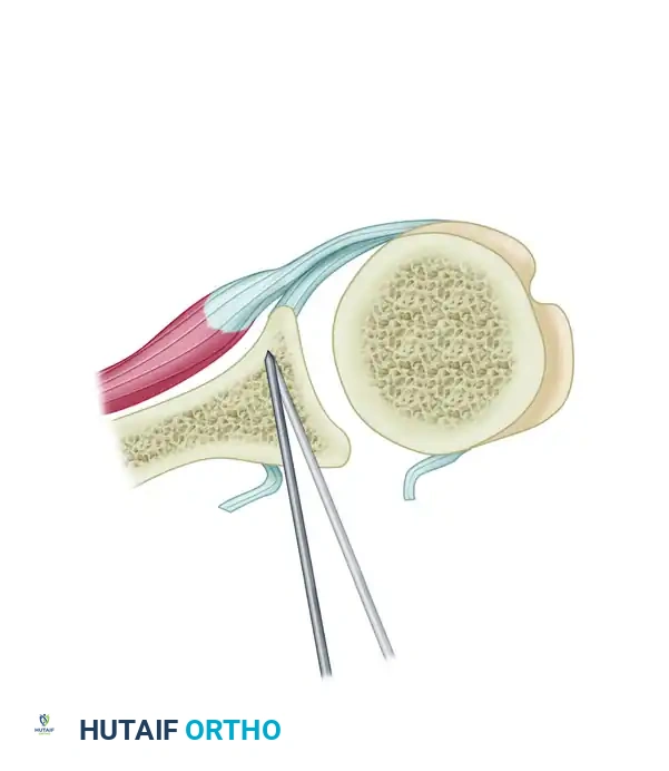 CAPSULAR SHIFT RECONSTRUCTION WITH POSTERIOR GLENOID OSTEOTOMY Surgical Diagram