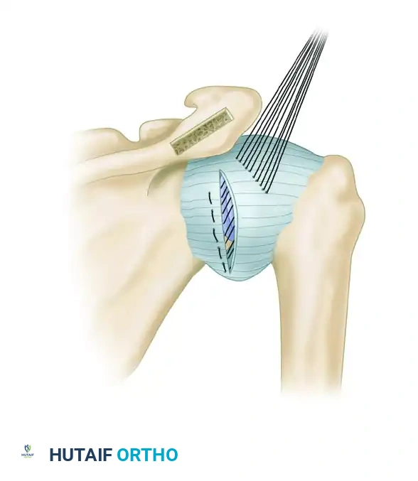 CAPSULAR SHIFT RECONSTRUCTION WITH POSTERIOR GLENOID OSTEOTOMY Surgical Diagram