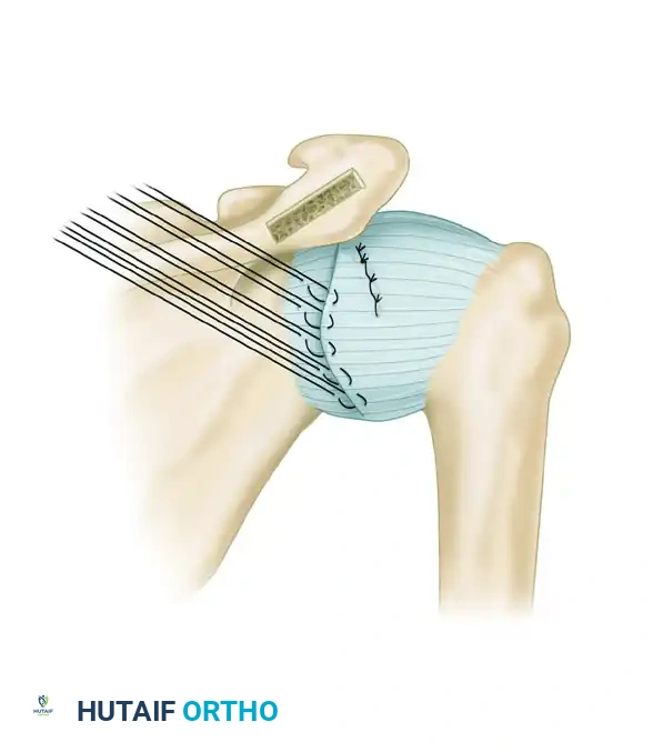 CAPSULAR SHIFT RECONSTRUCTION WITH POSTERIOR GLENOID OSTEOTOMY Surgical Diagram