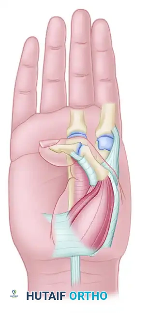 Surgical Management of the Spastic Hand: Proximal Row Carpectomy and Thumb-in-Palm Deformity Correction