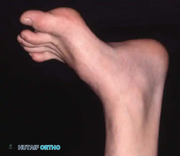 CAVUS FOOT Surgical Diagram