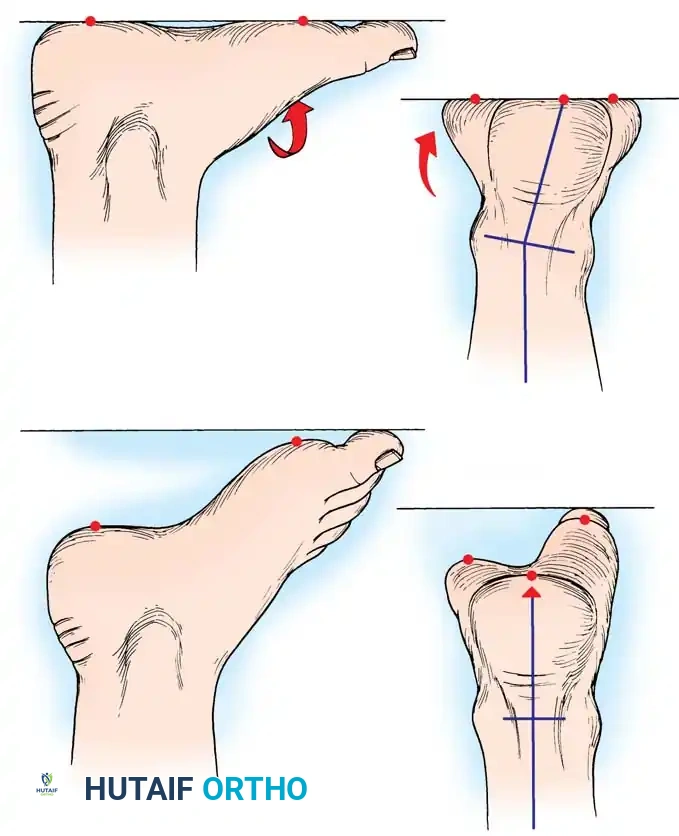 Biomechanics of Heel Varus