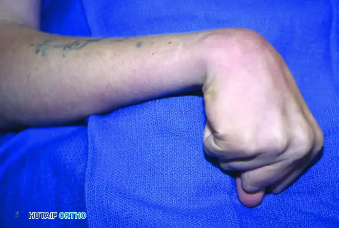 Cerebral Palsy of the Hand: Comprehensive Surgical Management