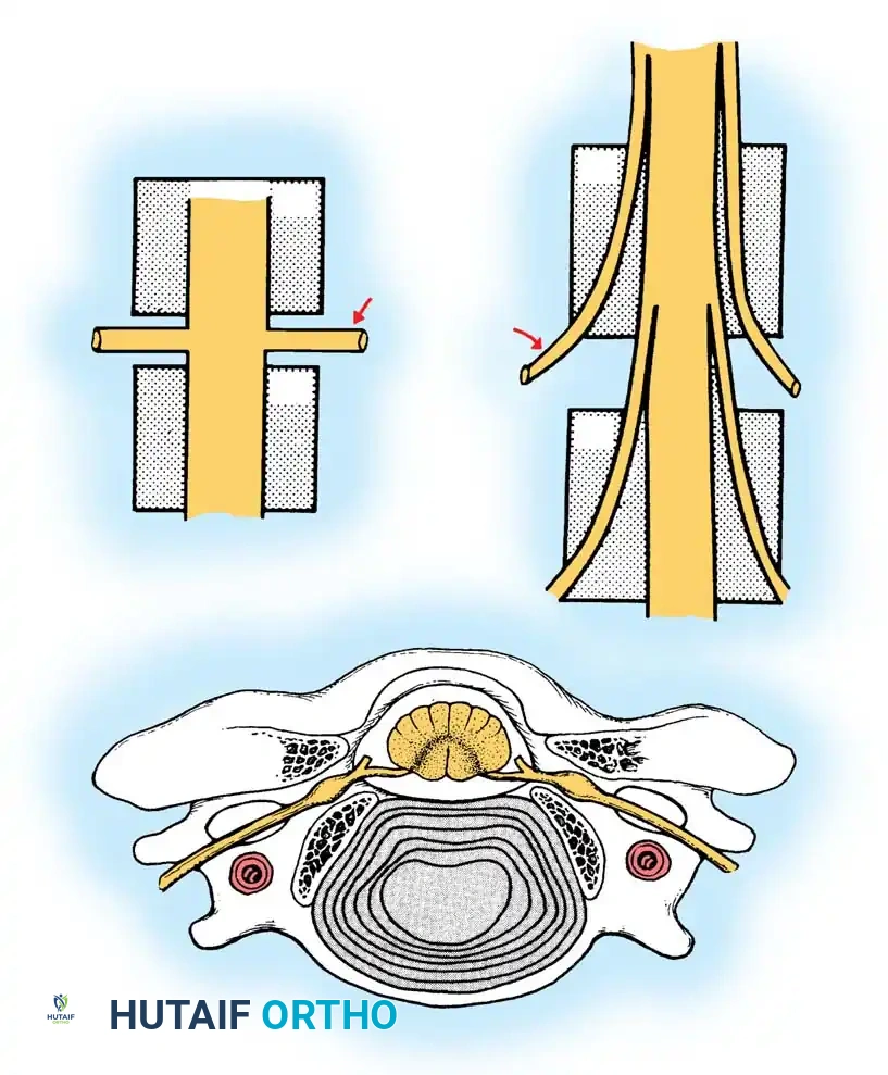 Cervical Disc Disease: Comprehensive Pathophysiology and Surgical Management