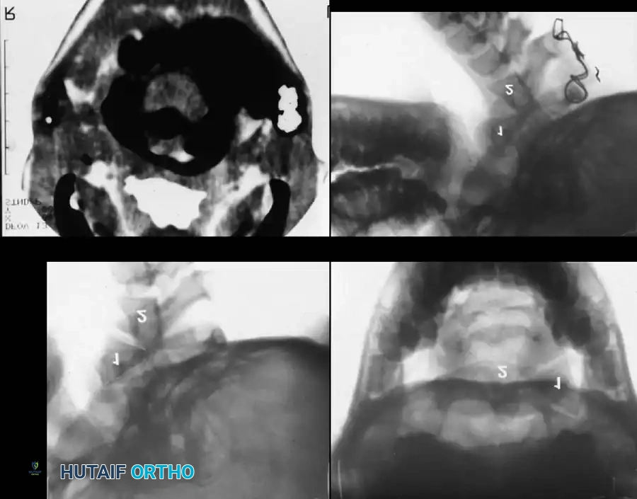 Cervical Instability in Down Syndrome: Comprehensive Surgical Management