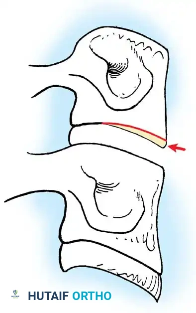 تحضير حواف الفقرات وإزالة الغضروف التالف
