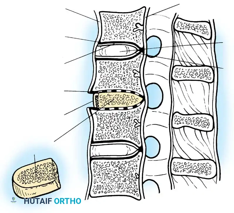 وضع الطعم العظمي بين الفقرات العنقية