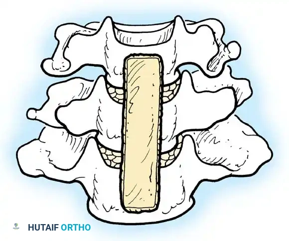 استئصال جسم الفقرة واستخدام دعامة معدنية في الحالات المعقدة