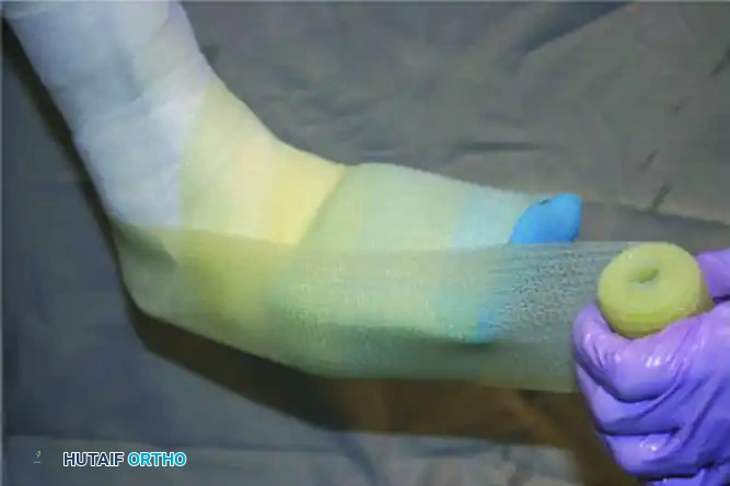 CHARCOT ARTHROPATHY Surgical Diagram