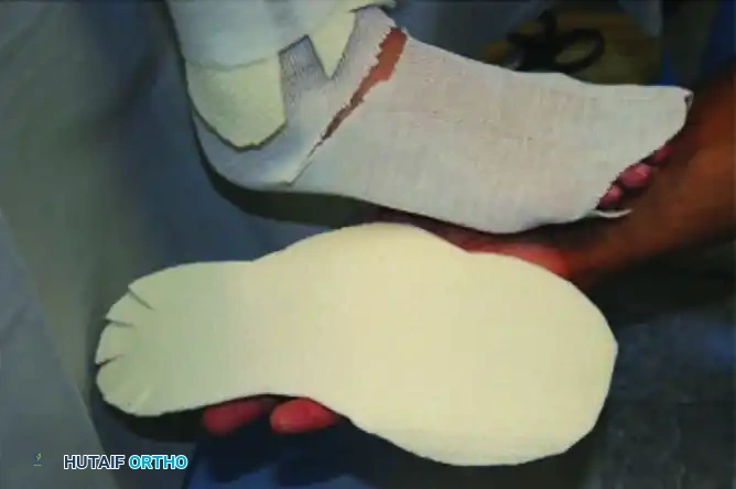 CHARCOT ARTHROPATHY Surgical Diagram