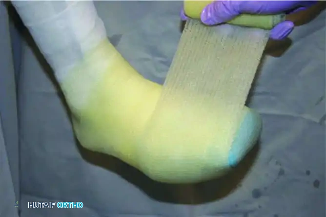 CHARCOT ARTHROPATHY Surgical Diagram