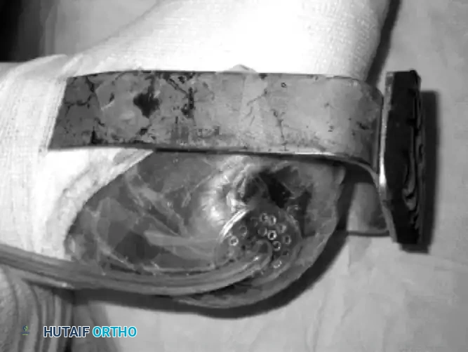 CHARCOT ARTHROPATHY Surgical Diagram