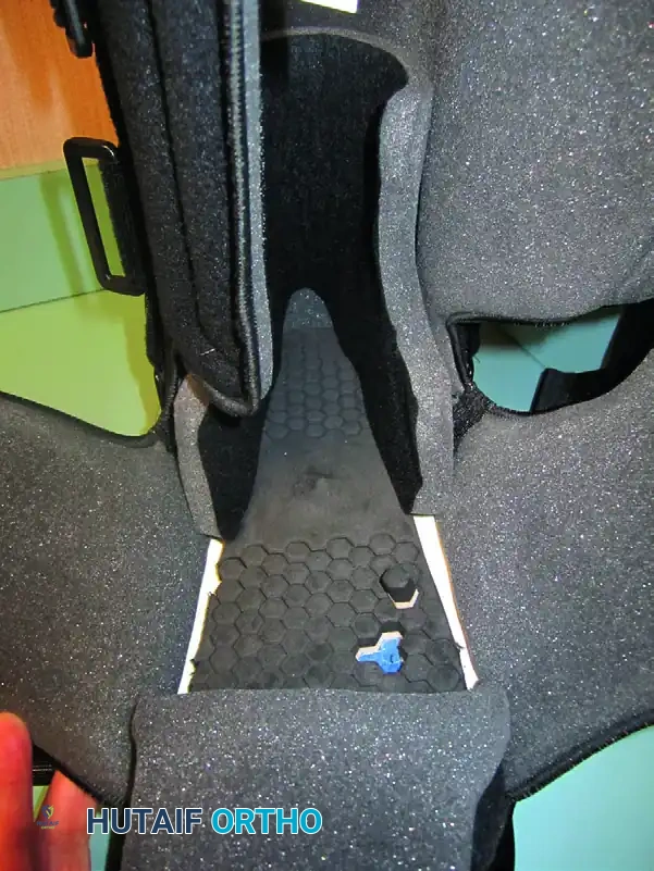 CHARCOT ARTHROPATHY Surgical Diagram