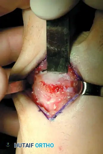 Metatarsal head resection