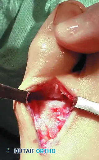 Joint distraction and ROM check