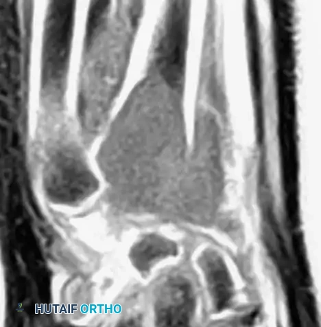CHONDROBLASTOMA Surgical Diagram