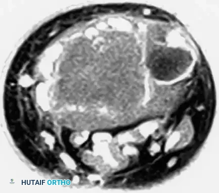 CHONDROBLASTOMA Surgical Diagram