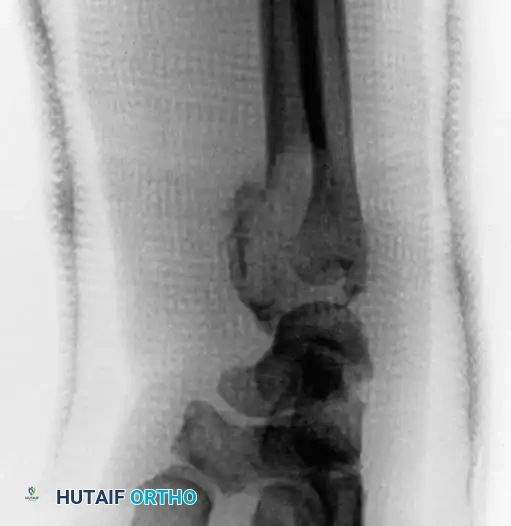 CHONDROBLASTOMA Surgical Diagram