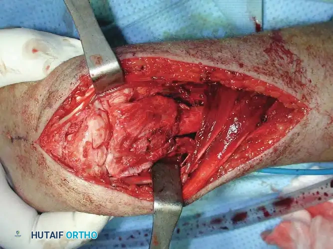 CHONDROBLASTOMA Surgical Diagram