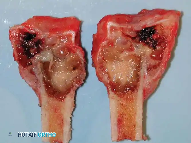 CHONDROBLASTOMA Surgical Diagram