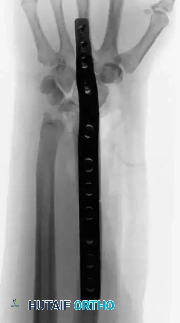 CHONDROBLASTOMA Surgical Diagram