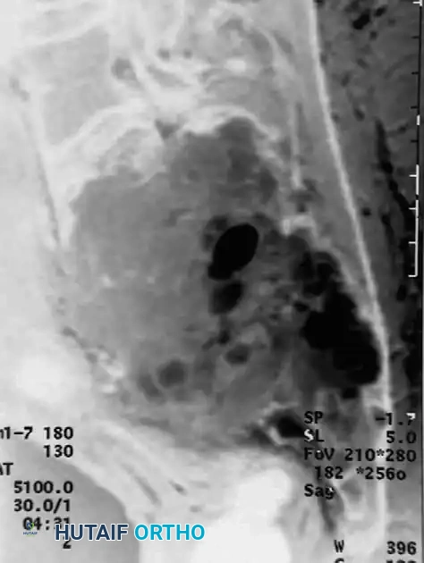 CHONDROBLASTOMA Surgical Diagram