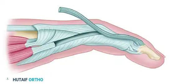 Chronic Mallet Finger Secondary Repair: Advanced Surgical Techniques