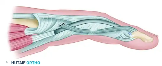 CHRONIC MALLET FINGER (SECONDARY REPAIR) Surgical Diagram