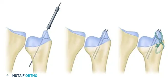 CLASSIFICATION Surgical Diagram