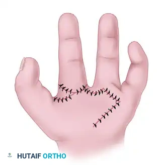 CLEFT CLOSURE AND RELEASE OF THUMB ADDUCTION CONTRACTURE Surgical Diagram
