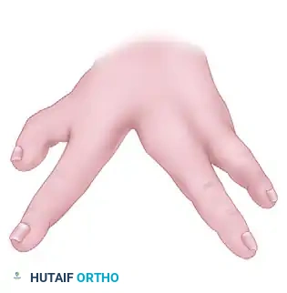 CLEFT CLOSURE AND RELEASE OF THUMB ADDUCTION CONTRACTURE Surgical Diagram