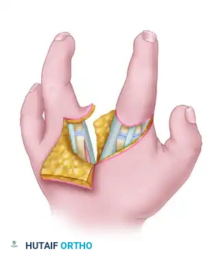 CLEFT CLOSURE AND RELEASE OF THUMB ADDUCTION CONTRACTURE Surgical Diagram