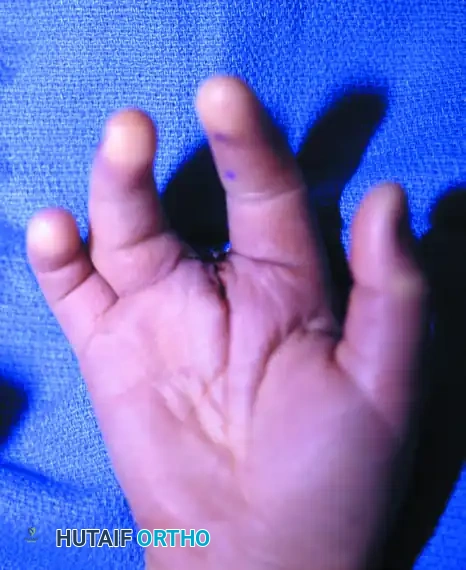 CLEFT CLOSURE Surgical Diagram