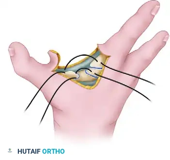 CLEFT CLOSURE Surgical Diagram
