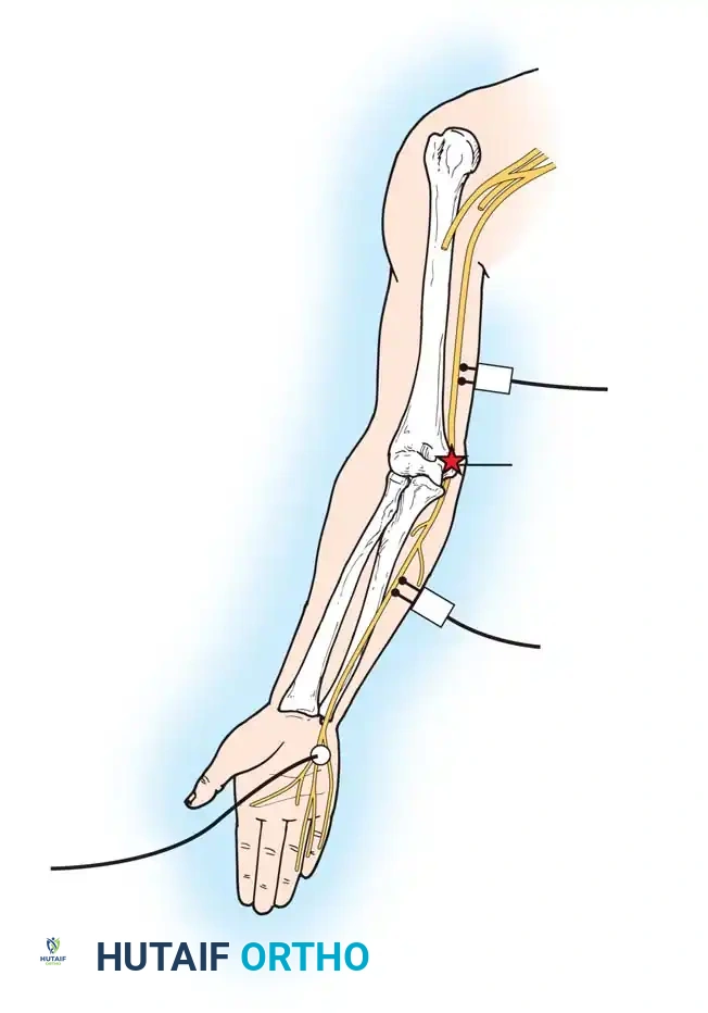 Clinical Diagnosis and Surgical Evaluation of Peripheral Nerve Injuries