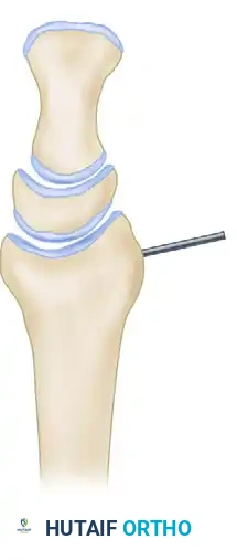Dorsal Tilting Malunion