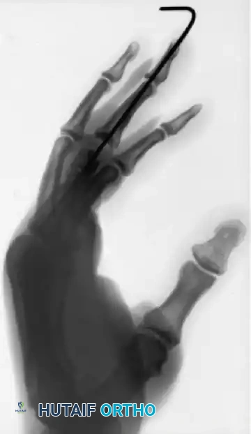 Closed Pinning Techniques for Hand Fractures