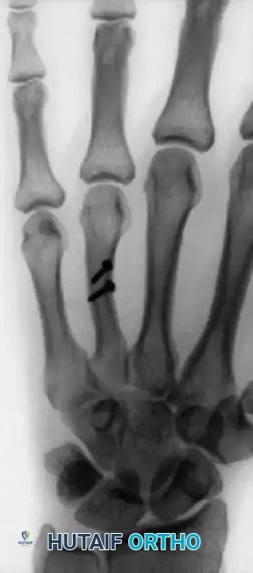 CLOSED PINNING Surgical Diagram